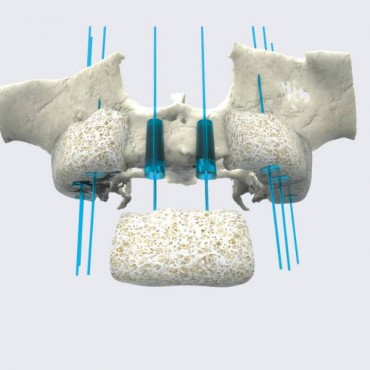 Enxerto Ósseo em Nova Hartz - RS