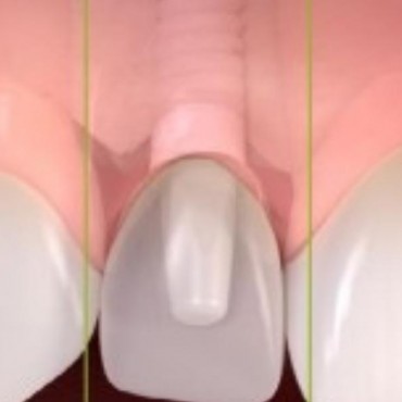 Cirurgia Guiada em Nova Hartz - RS