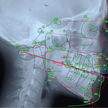 Cirurgia Ortognática em Nova Hartz - RS