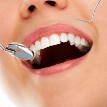 Recobrimento de Exposição Radicular em Nova Hartz - RS