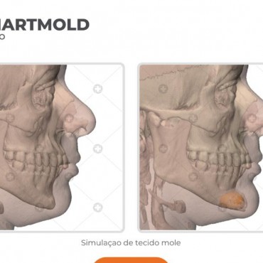 Mentoplastia em Nova Hartz - RS
