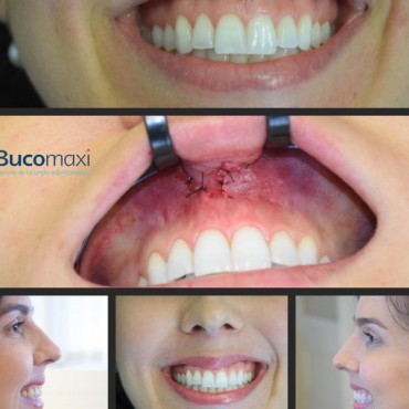 Redução do Sorriso Gengival em Nova Hartz - RS