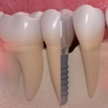 Implantes Dentários em Nova Hartz - RS