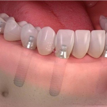 Carga Precoce em Nova Hartz - RS